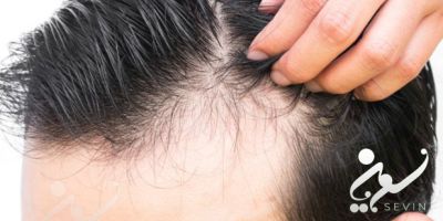 کاشت مو بلند در شقیقه‌